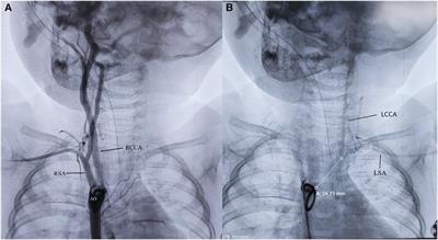 Case Report: Right aortic arch with isolation of left brachiocephalic artery and ventricular septal defect